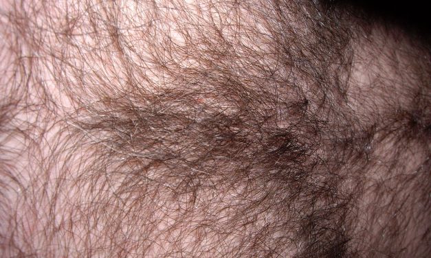 Hypertrichose, que nous réserve l&rsquo;avenir ?